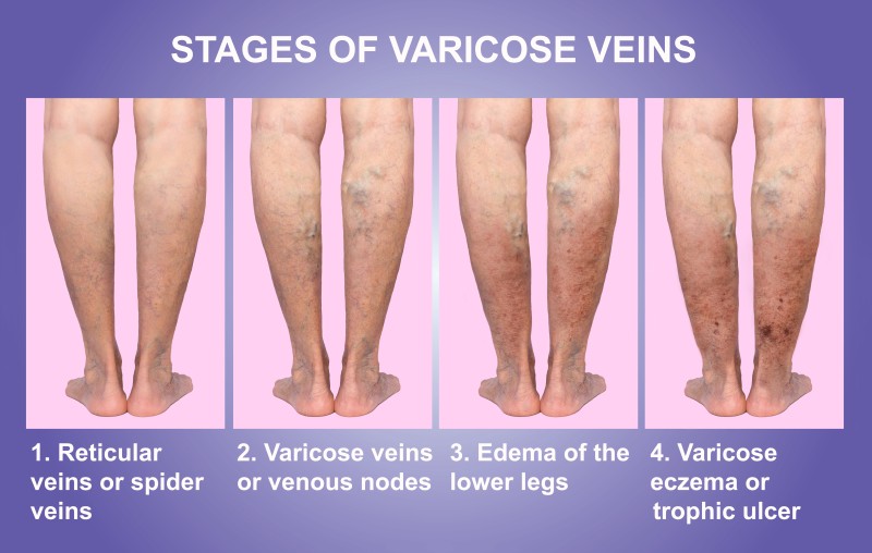 Effective Varicose Vein Treatment in Schaumburg, IL